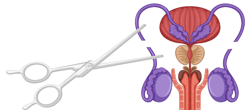 Vasectomy