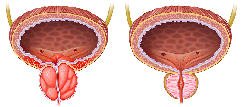 Prostate conditions